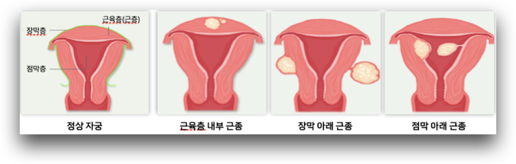 자궁근종의 종류를 자궁내 근종의 위치에 따라 분류한 그림입니다.