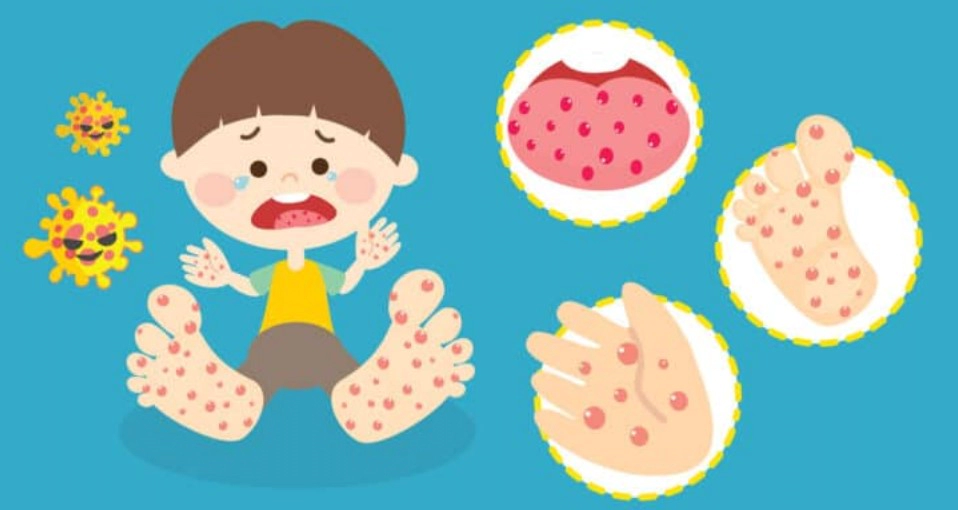 수족구 증상 전염 잠복기 등 수족구 완벽정리 