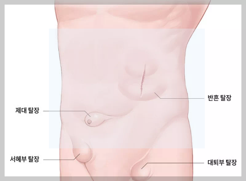 탈장 종류