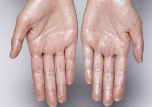 다한증 치료 원인 수술 다한증에 좋은 음식 총정리