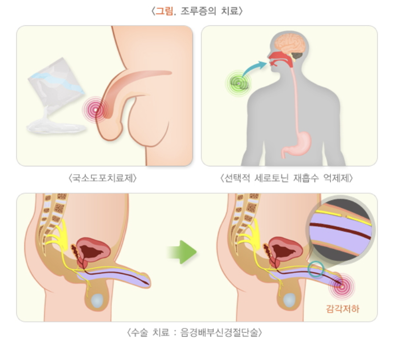 조루증의 치료법