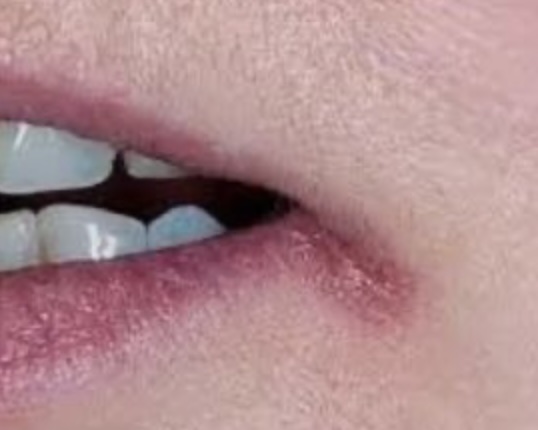 구각염: 원인, 증상, 치료 및 예방