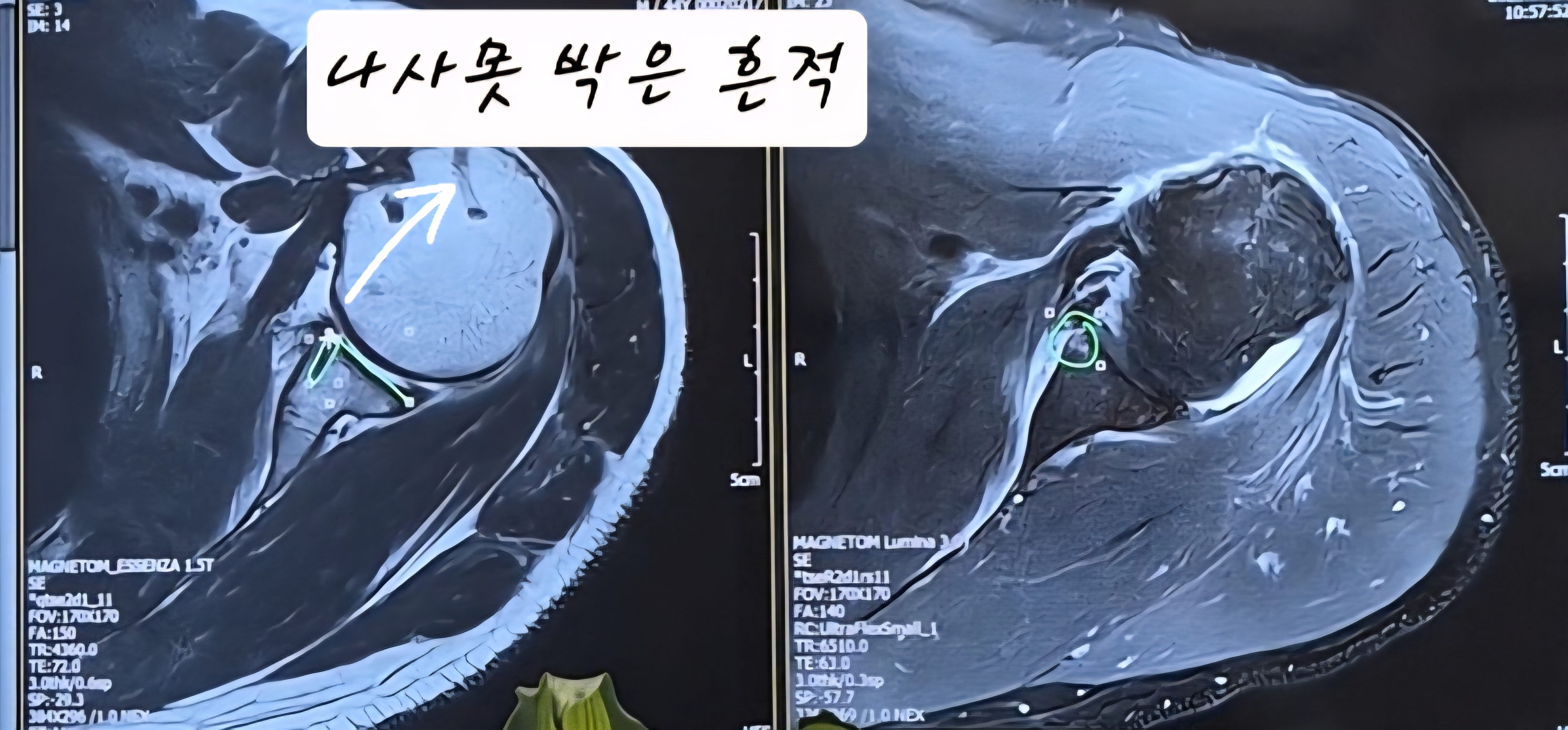 어깨 와순파열 봉합수술 후 mri사진 물리치료 기록