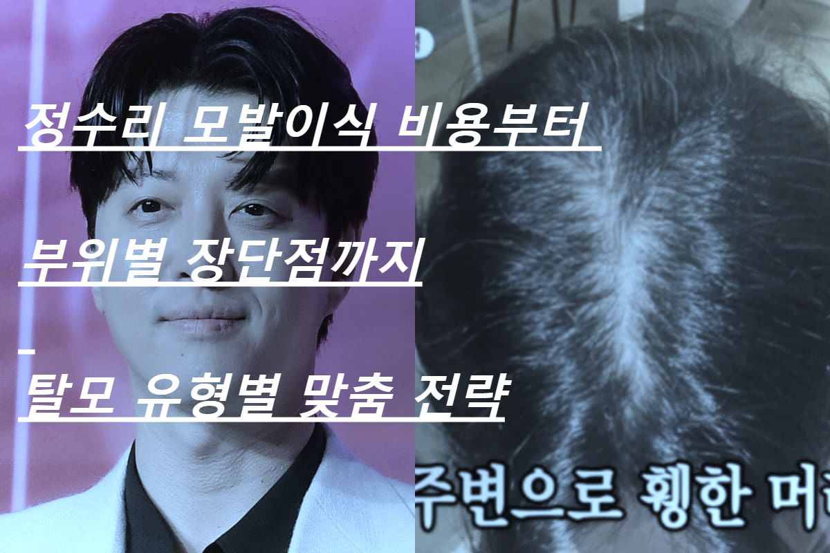 정수리 모발이식 비용부터 부위별 장단점까지 탈모 유형별 맞춤 전략