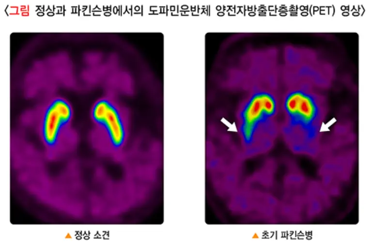 파킨슨병-양전자방출단층촬영-이미지