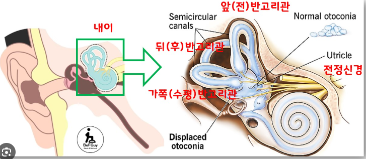 이석증 원인