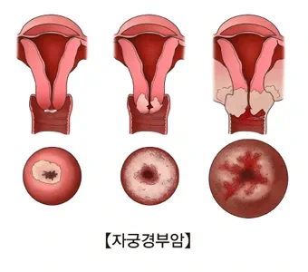HPV 바이러스