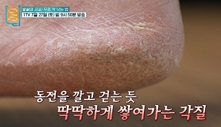 무좀싹낫는법