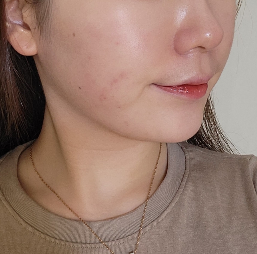 bbl 레이저 후기