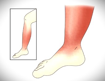 봉와직염이 생긴 다리 그림