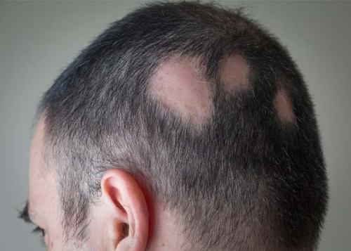 Alopecia Areata