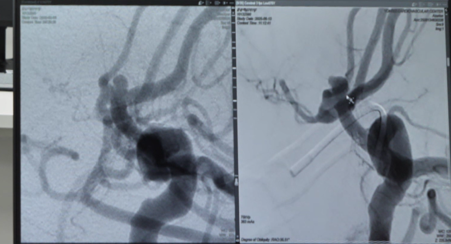 명의 뇌 뇌동맥류