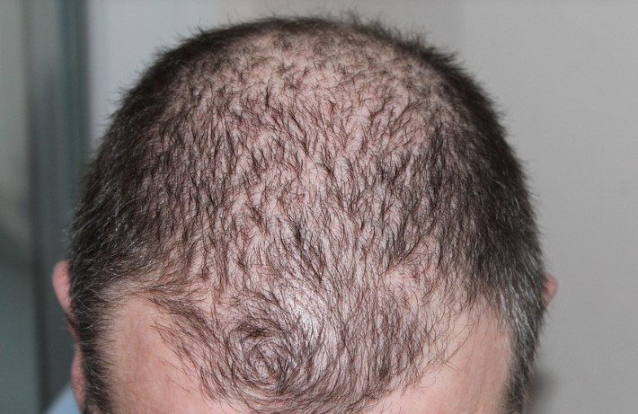 탈모약
탈모약 부작용
탈모치료제
탈모치료제 부작용
탈모치료제 종류
탈모치료시기