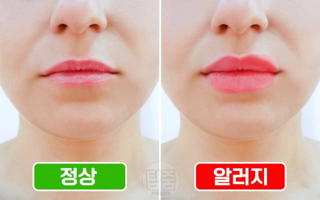 입술 붓기 알러지 접촉입술염