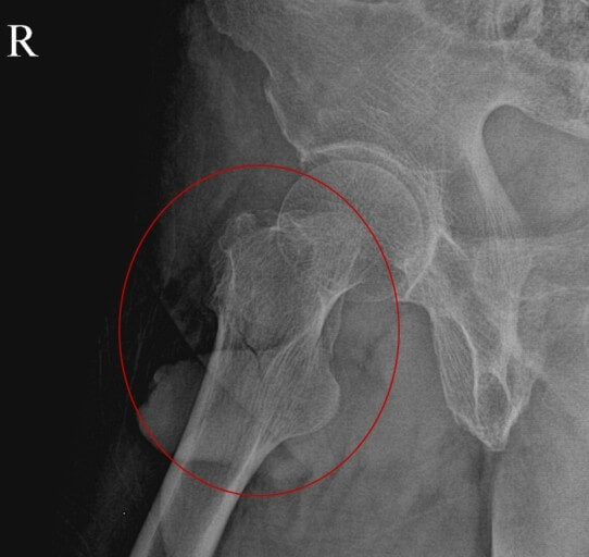 대퇴골전자간 골절