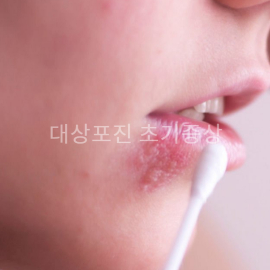 대상포진 초기 증상3