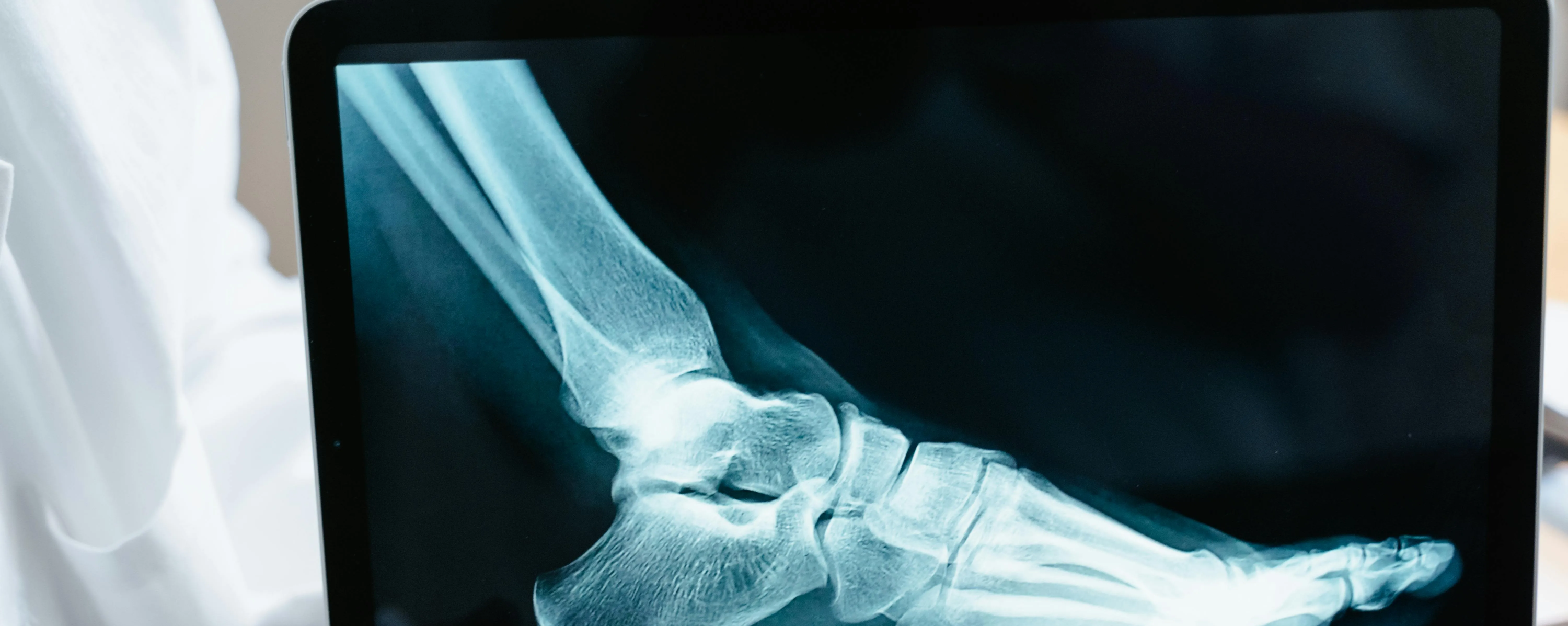 콘드로이친-효능-후기-무릎-과절염-퇴행성관절염1