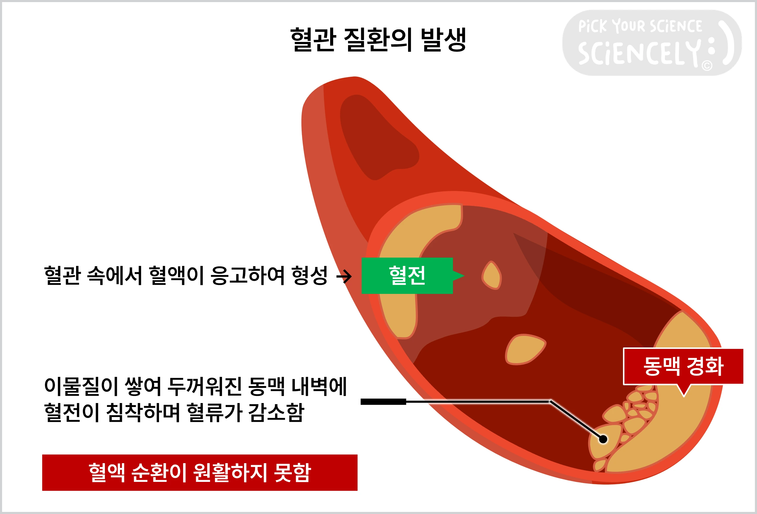 혈관 질환, 혈전, 동맥 경화, 혈액 순환