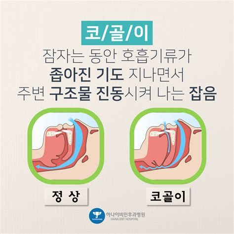 코골이 고치는 법