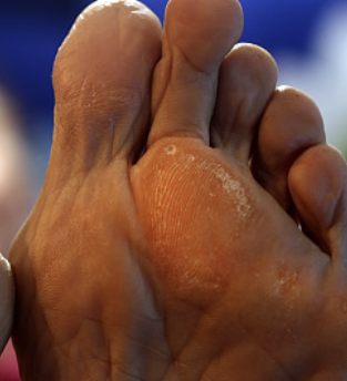 티눈 없애는 방법