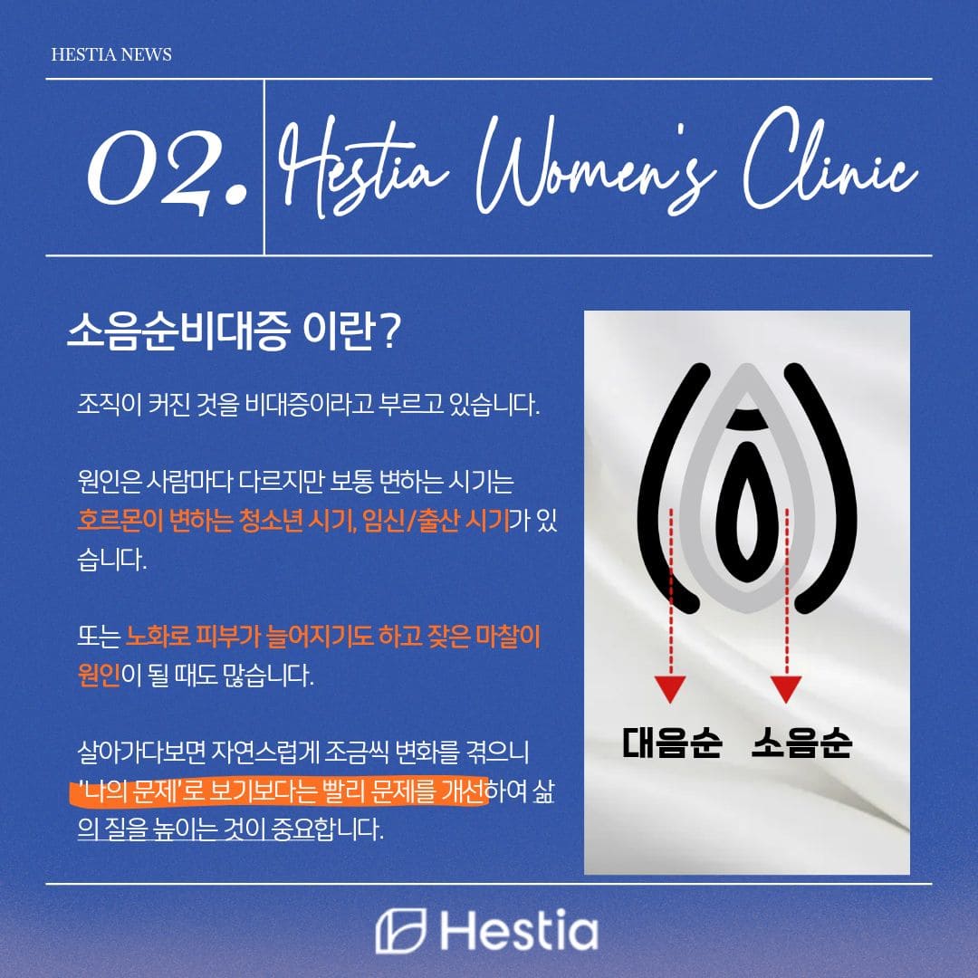 소음순비대증 이란?