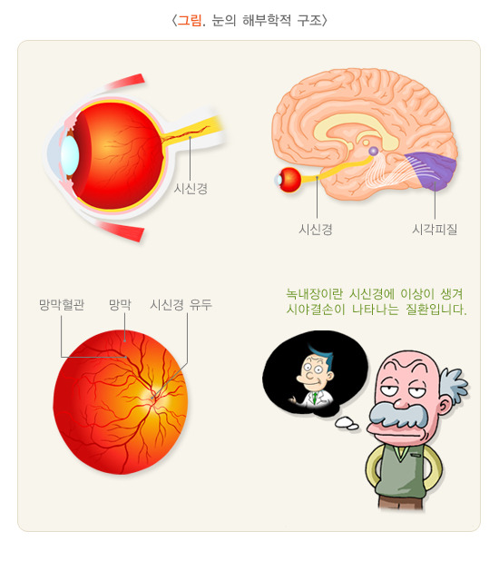 녹내장 수술 비용&amp;#44; 초기증상