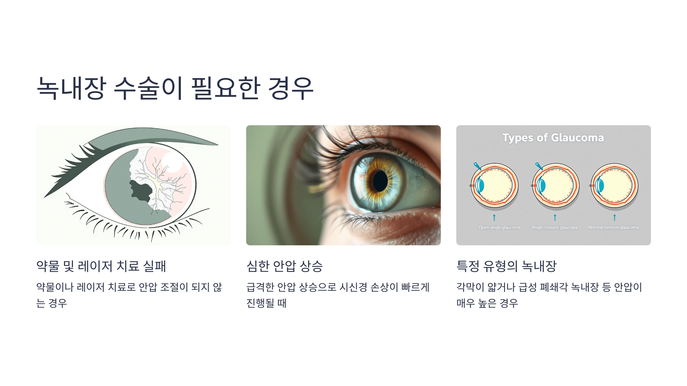 녹내장과 관련된 사진입니다.