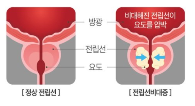 전립선비대증 치료와 좋은음식 총정리