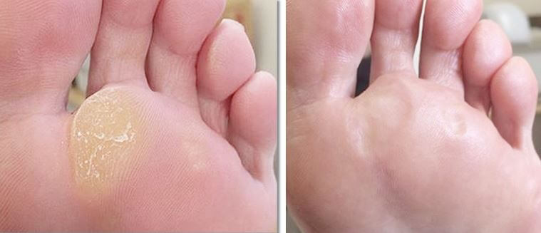 발톱 무좀 치료 후 호전 상태