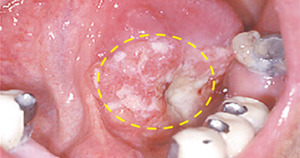 구강암 증상과 원인&amp;#44; 조기 발견이 생명을 살린다 
