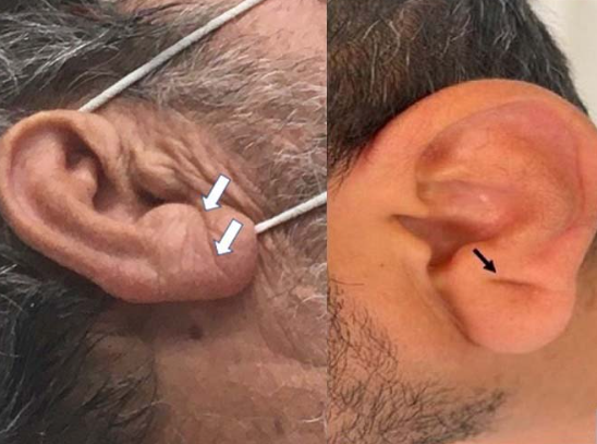 심혈관-뇌경색-질환-귓불-프랭크징후-특징-근거-연령-사진-