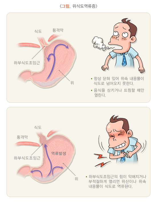 역류성식도염