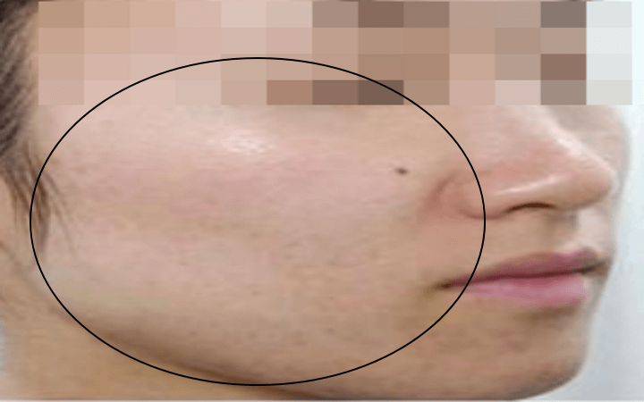 프락셀 레이저 시술 후 얼굴의 상태