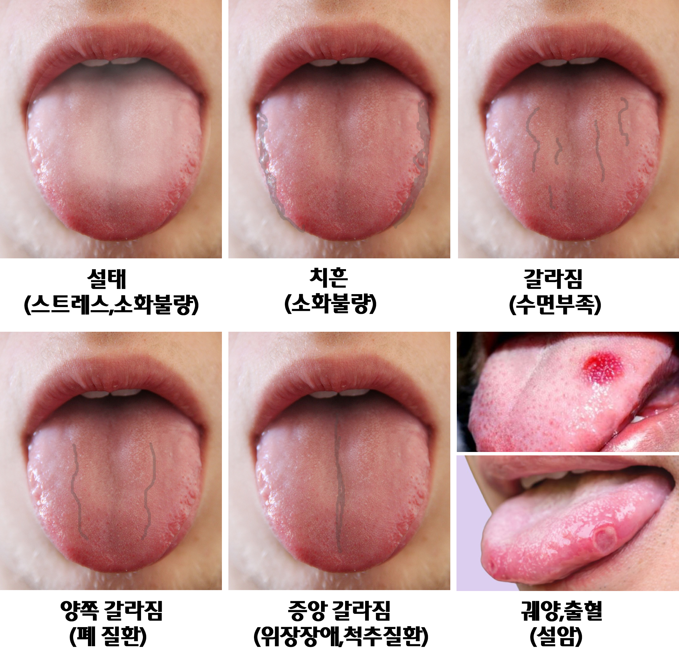 혀모양에 따른 건강상태