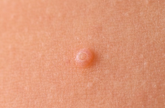 얼굴, 손바닥, 손등 물사마귀 생기는 이유(원인), 없애는 방법(제거)