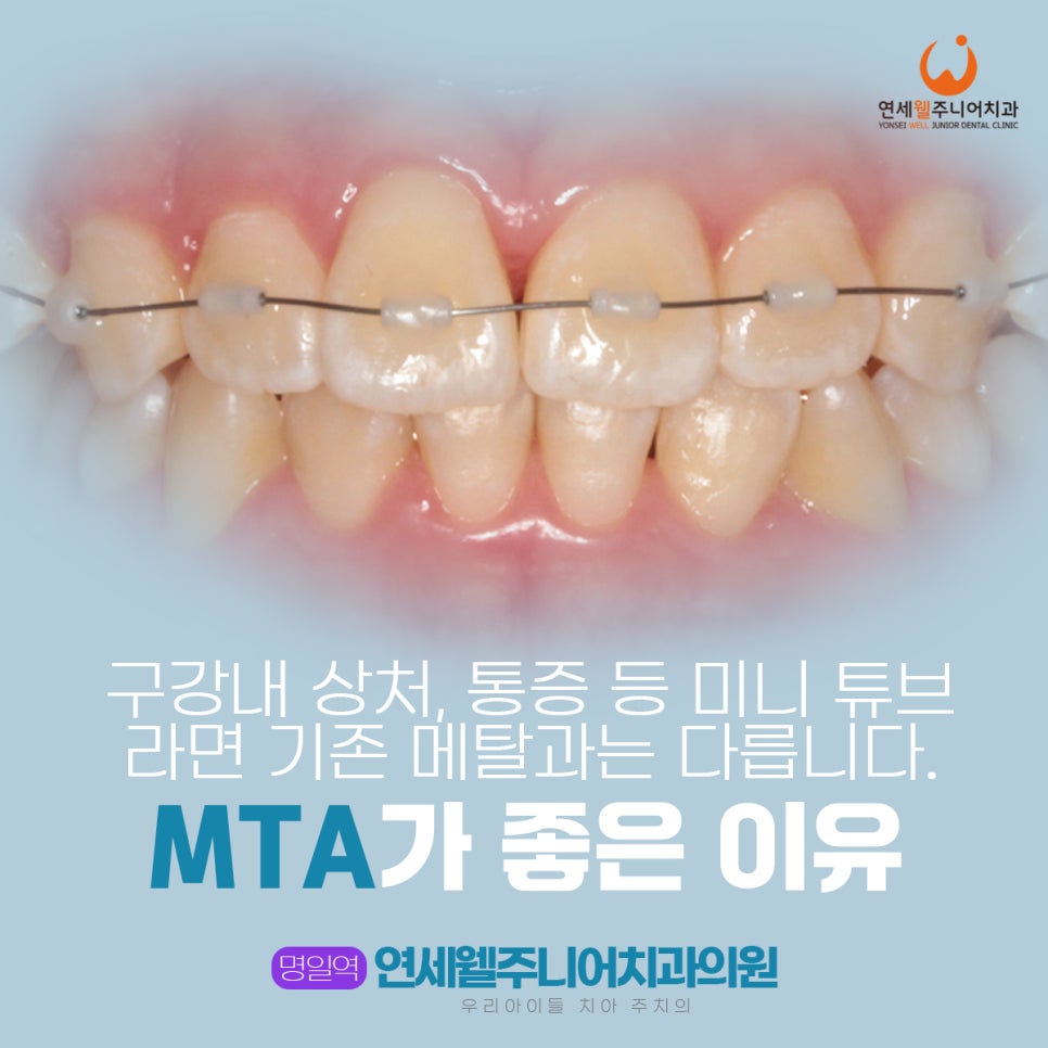 어린이 MTA 교정에 사용하는 미니 튜브 교정장치