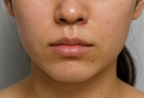 넓은 모공의 지성피부의 여성의 피부표현