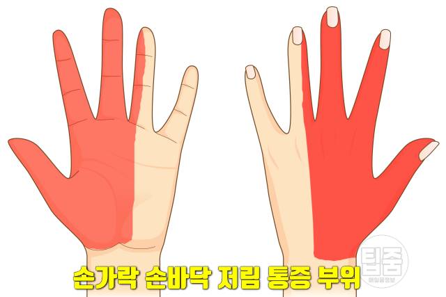 손가락 손바닥 찌릿찌릿 저림,손목터널증후군 증상