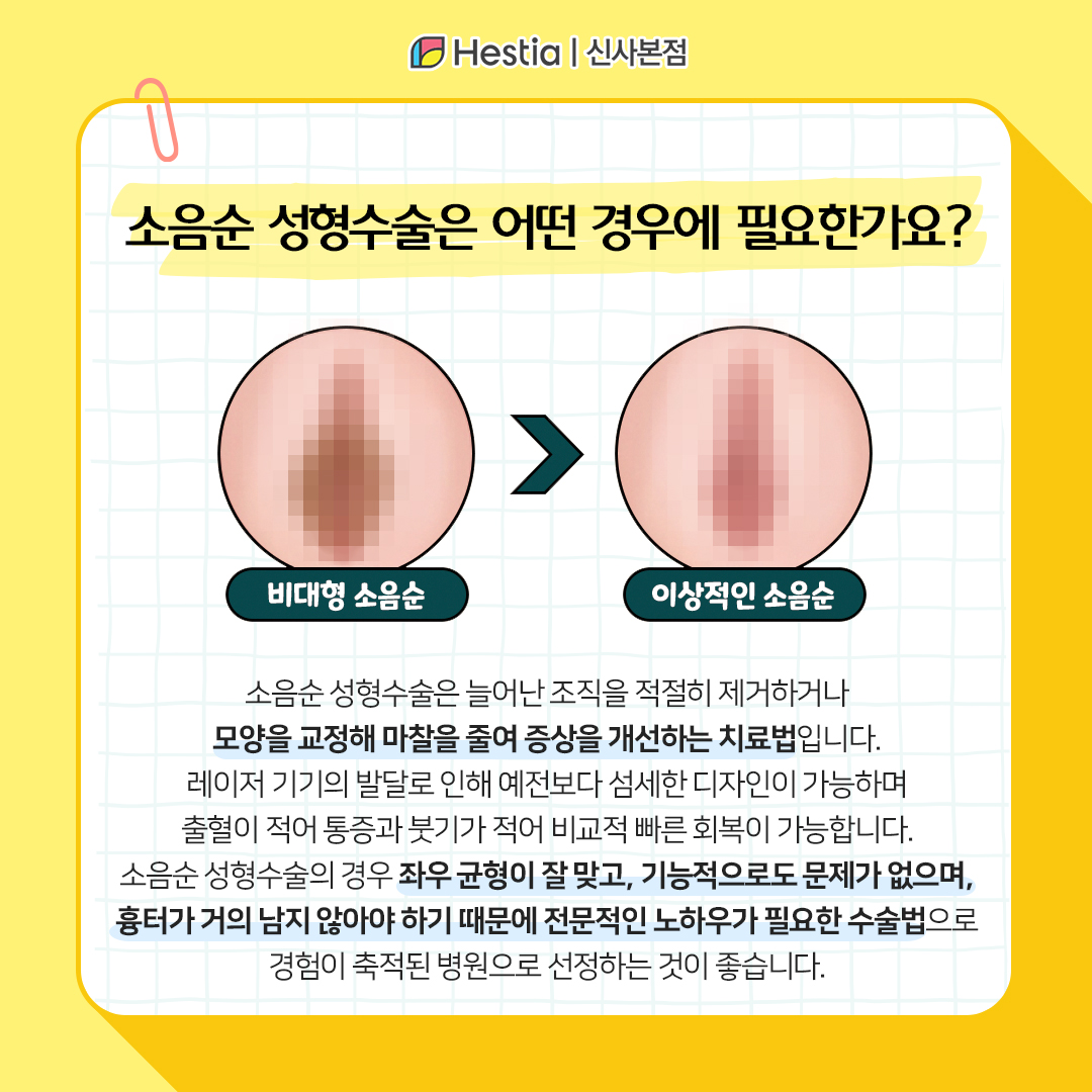 소음순 성형수술 어떤 경우 필요한거죠?