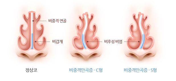 비중격만곡증