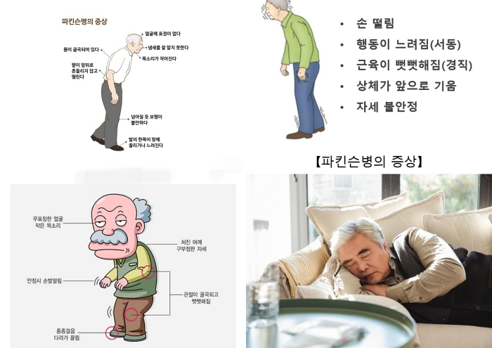 파킨슨병 전조증상 및 초기증상