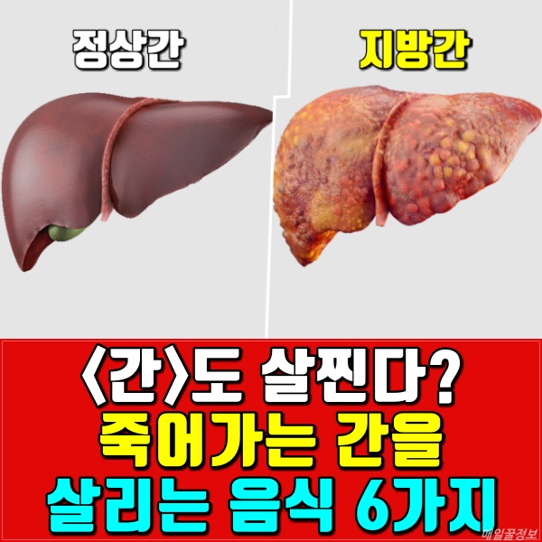 간에 좋은 음식,지방간에 좋은 음식,간암,간경화