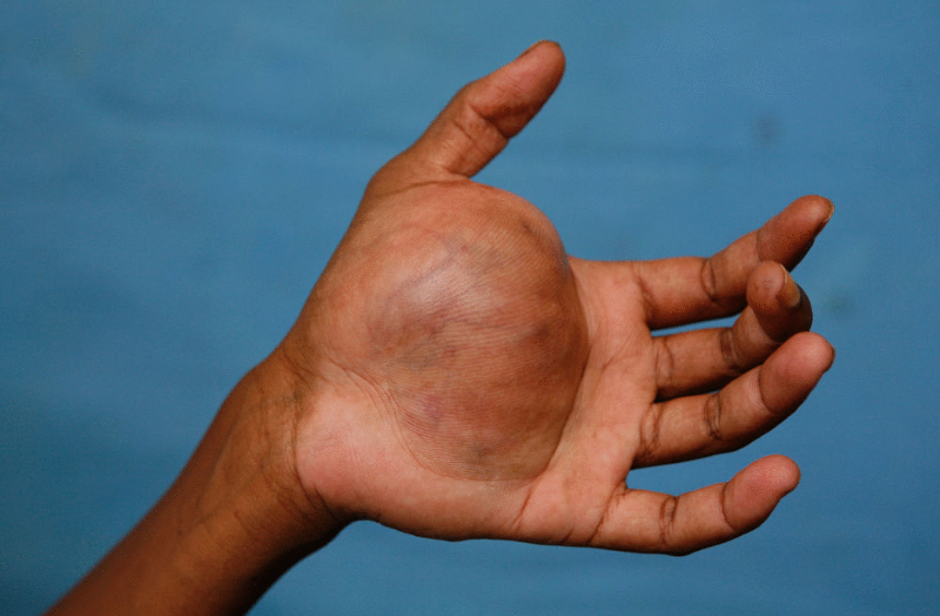 신경섬유종 초기 증상, 혹시 나도? 놓치면 안 되는 신호