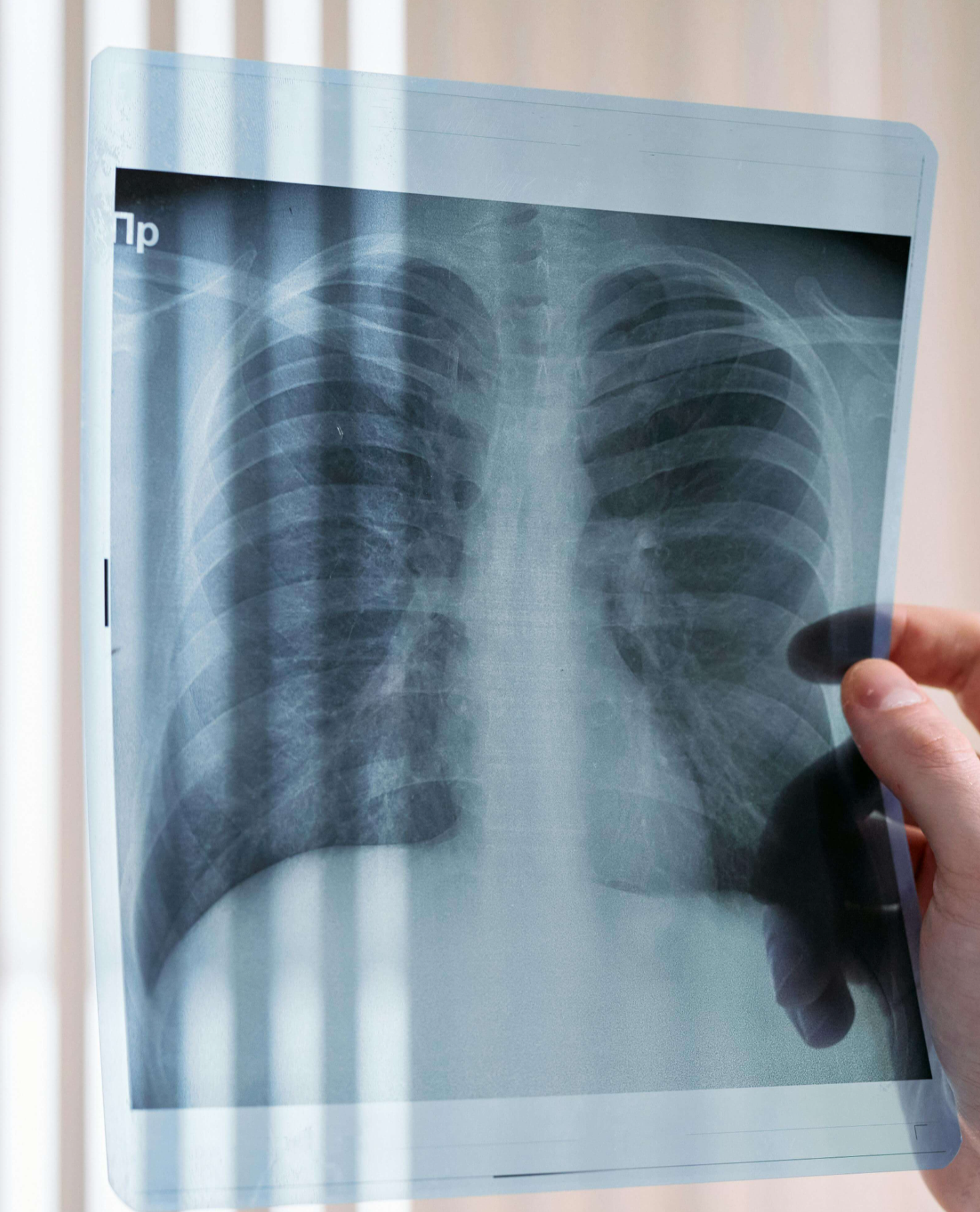 고립성 폐결절 증상과 원인 수술 치료법 정리