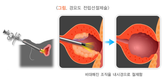 전립선절제술을-표현한-그림