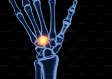 손목 터널 증후군 치료법 증상 수술비용 및 수술법 손목 터널 증후군 운동 수술 후 관리