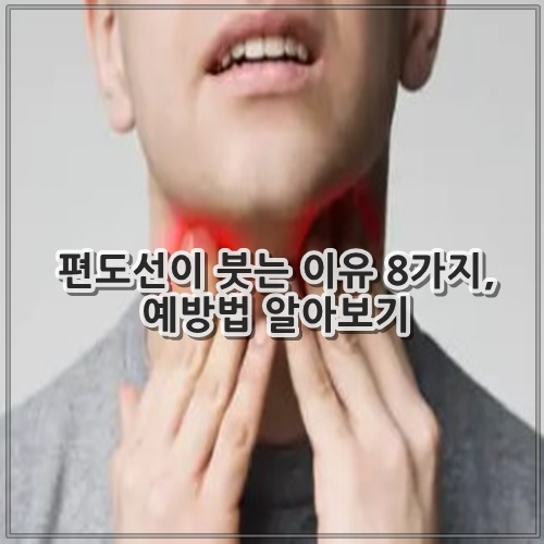 편도선이 붓는 이유 8가지, 예방법 알아보기