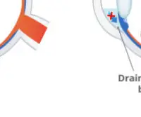 녹내장 초기 증상 &mdash; 시야를 서서히 빼앗는 침묵의 질환