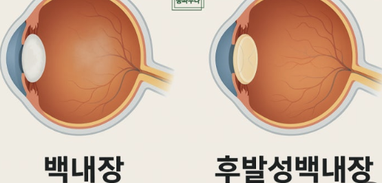 백내장 원인과 치료방법