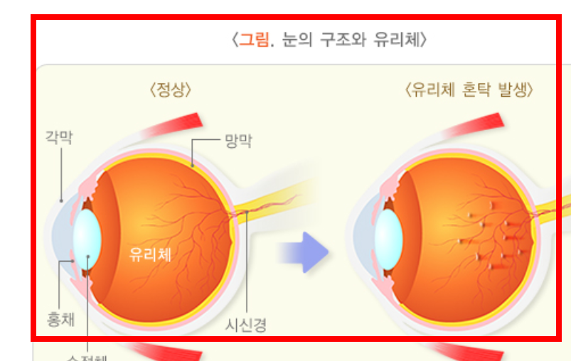 비문증 치료방법 알아보기